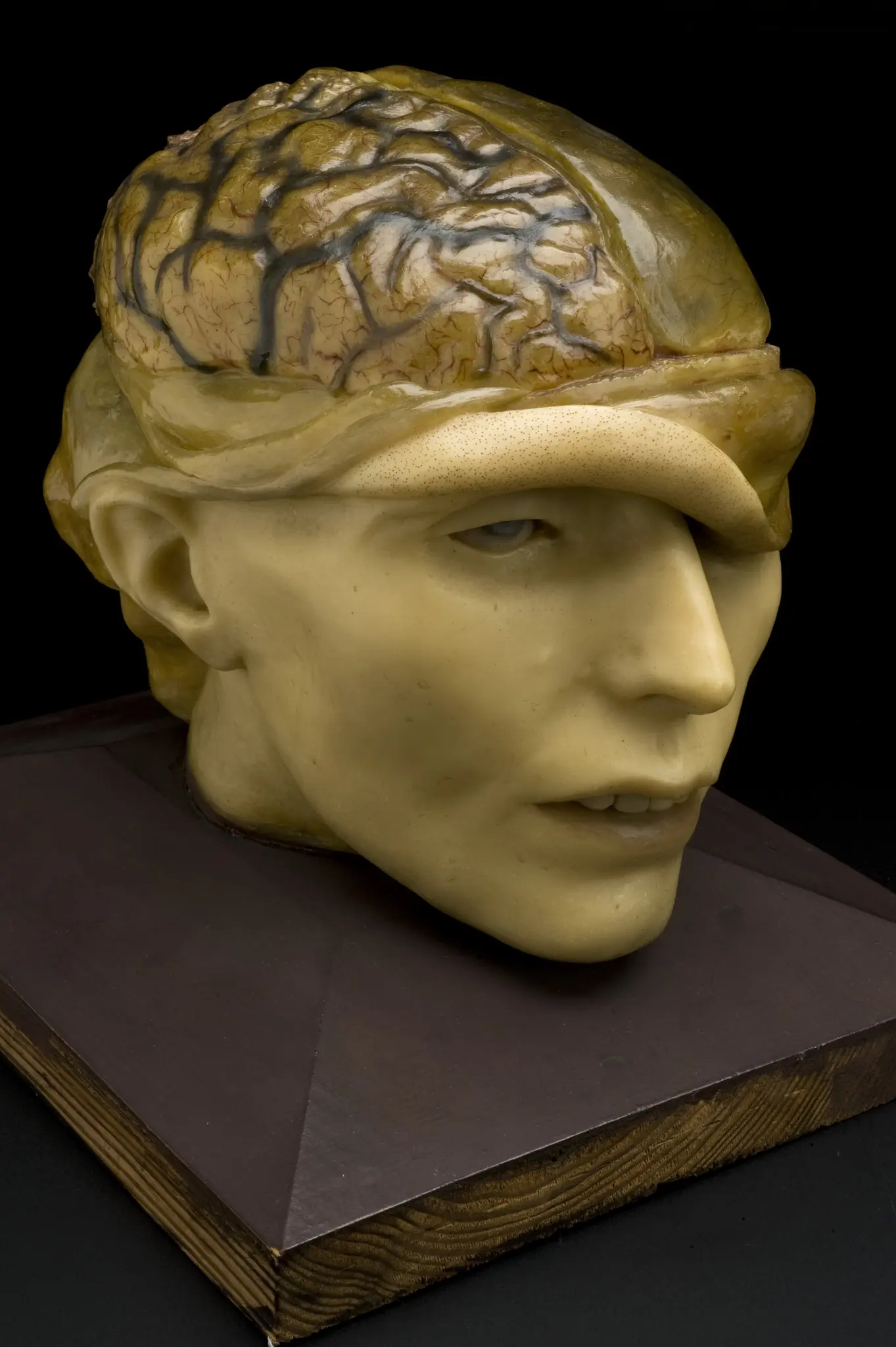 An instance of SCP-3087-1a was recovered during a later expedition. Its head is shown mid-dissection. An instance of SCP-3087-1a was recovered during a later expedition. Its head is shown mid-dissection.